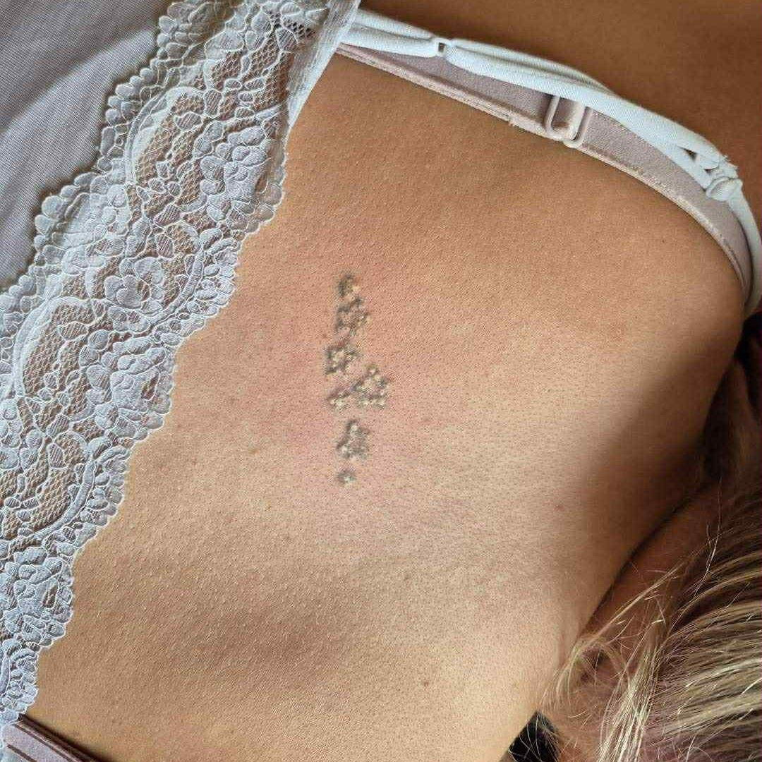 tattoo removal af lille tatovering