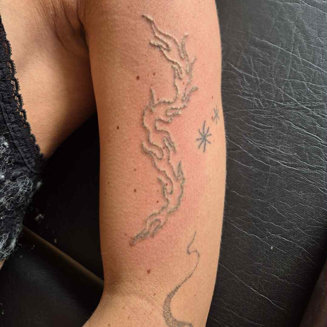 tatoveringsfjernelse af mellem tatovering med Pico laser