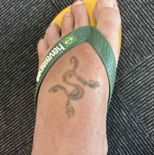 Tattooremoval af mindre tatovering med Pico laser