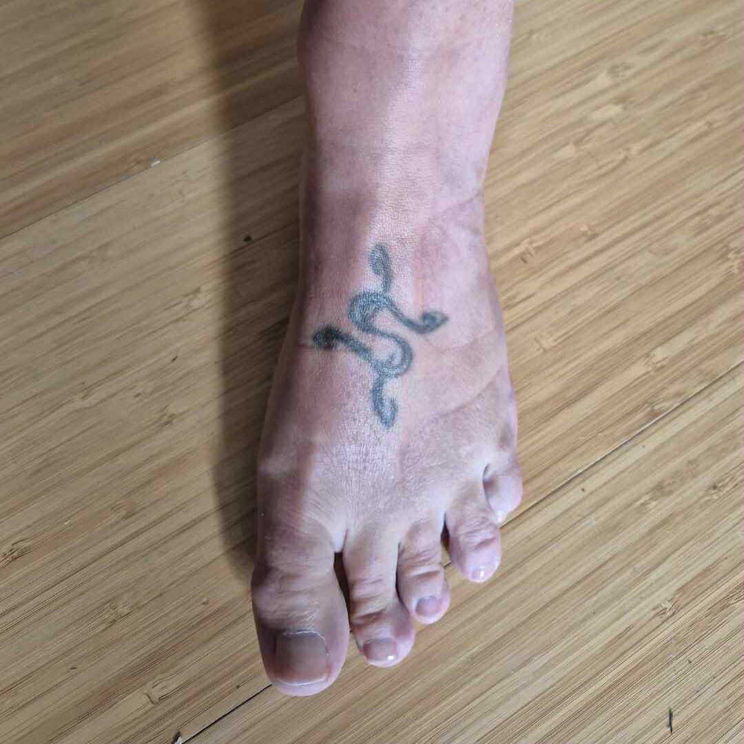 Tattoo removal af mindre tatovering med Pico laser