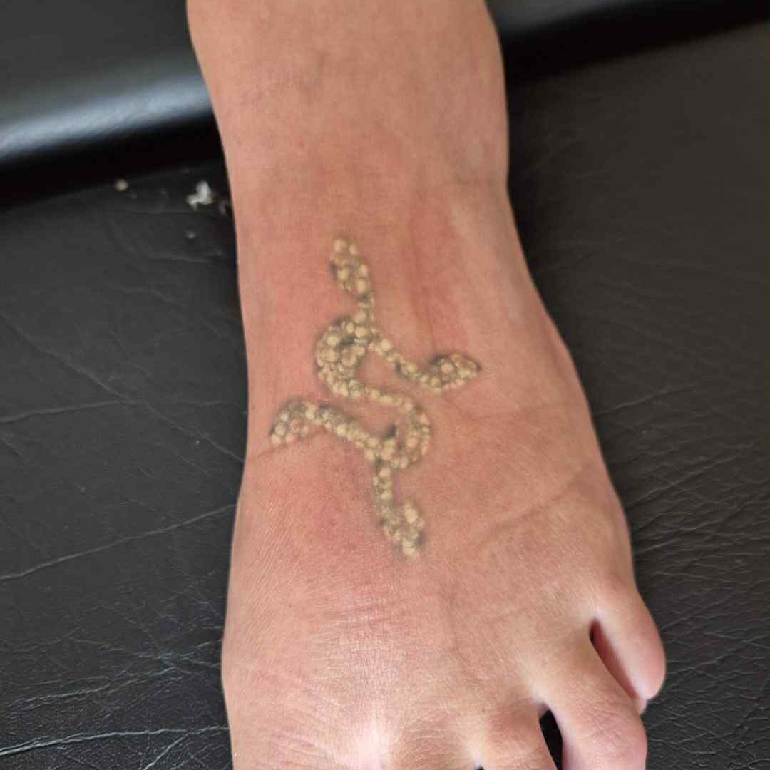 Tatoveringsfjernelse af mindre tatovering med laser