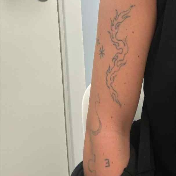 Tattoo removal af mellem tatovering